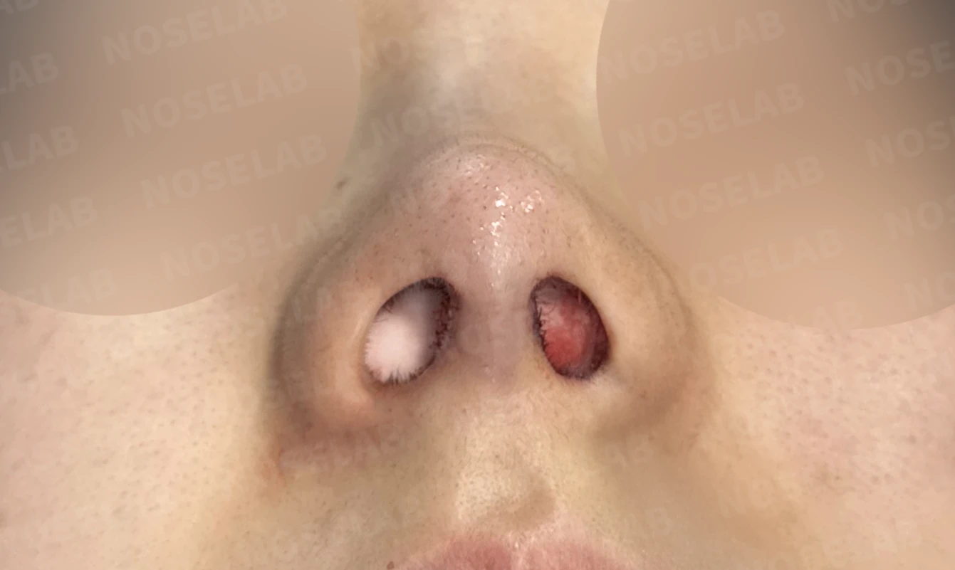 안면 비대칭과 휜코, 자가늑연골 비중격 재건으로 자연스럽게 교정한 코성형 — 전(좌) 직후(후)
