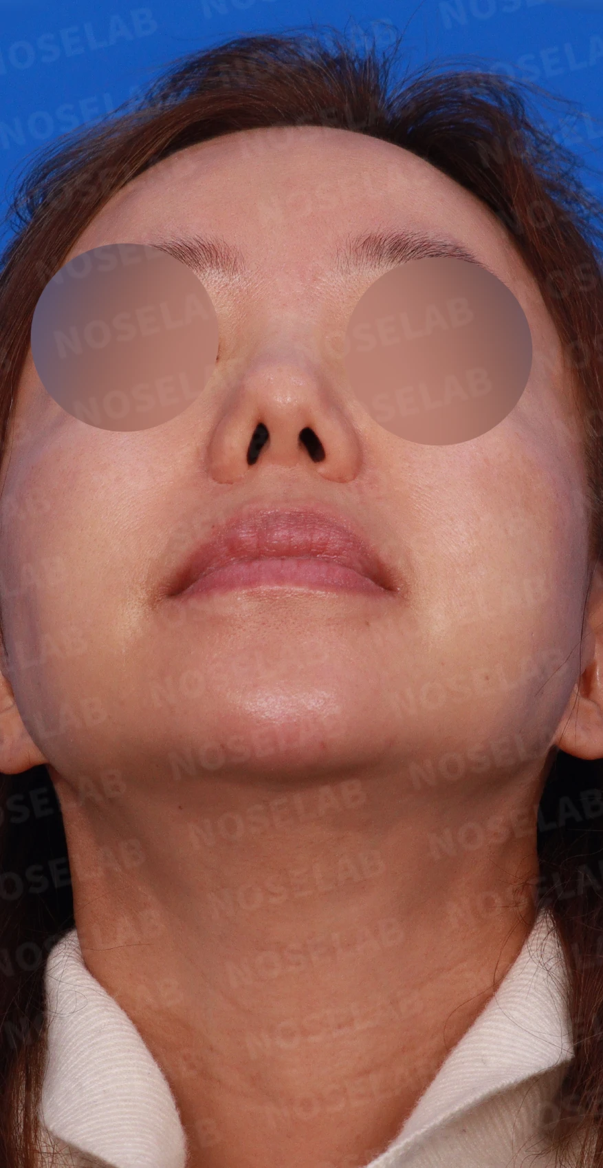 보형물을 제거한 뒤 콧대가 꺼지고 퍼지는 이유, 재건은 어떻게 하나 — 디자인 상담 우측 비스듬한 측면, 측면, 비공 사진