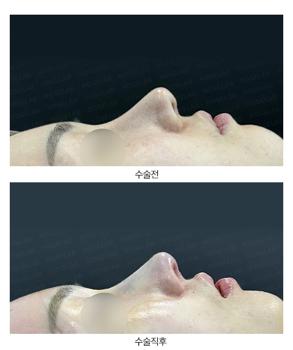 티나는 코 자연스러운 무보형물 코로~ — 전후 비교
