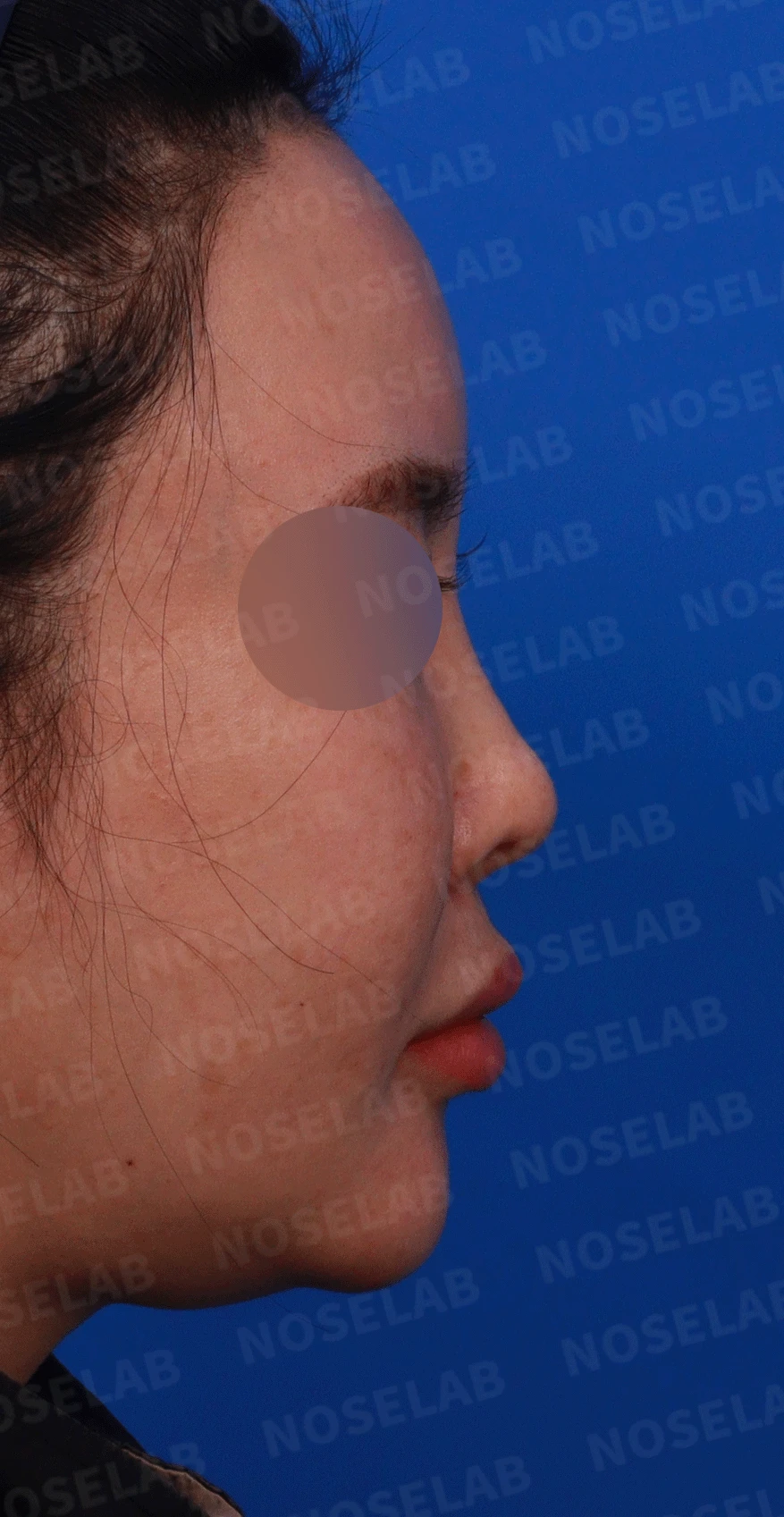 제거했다던 주사 이물질이 남는 이유와 들린 코끝 교정 방법 — 디자인 상담 우측 비스듬한 측면, 측면, 비공 사진입니다.