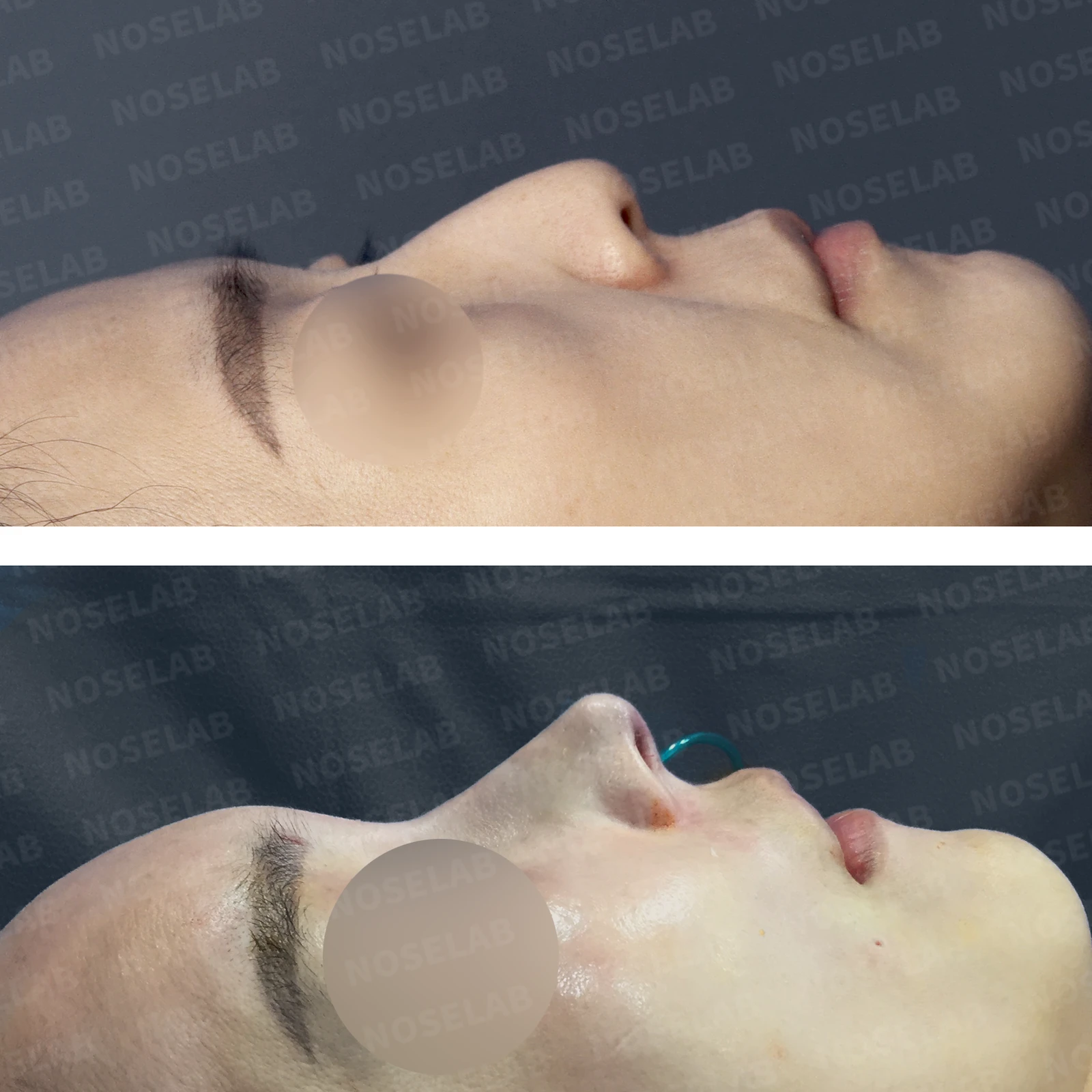 들창코, 매부리코, 휜코까지 한번에 완벽 교정! — 본문 사진 17