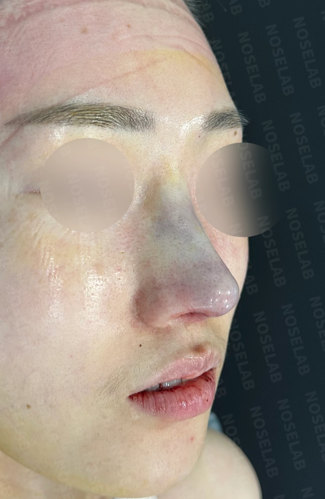 수술한 티가 나는 코의 무보형물 재수술 방법 — 수술 직후 0일 사진 90도, 45도, 정면 직후 사진은 부기가 있는 상태로 최종 결과와 다를 수 있습니다.