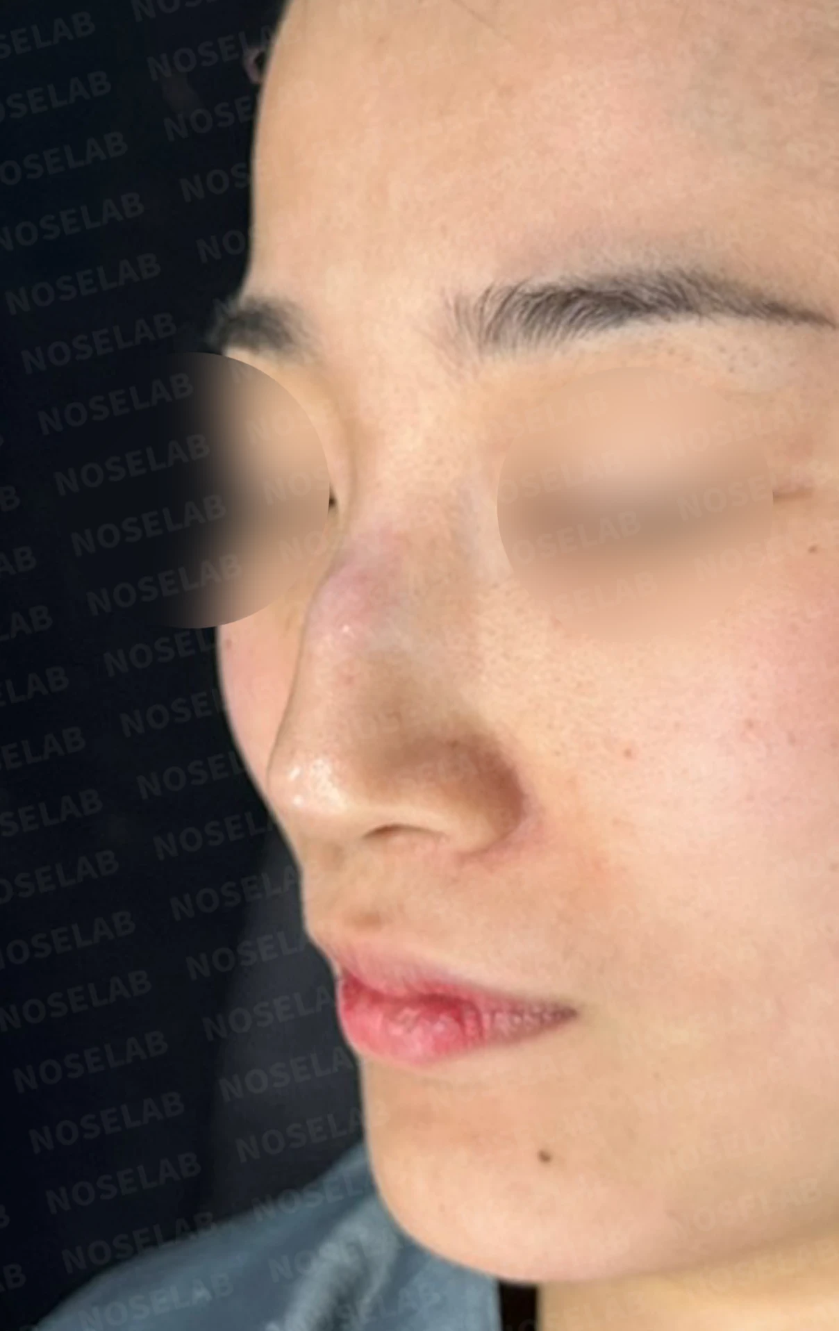 메드포어 점막 돌출로 인한 염증 코 - 자가늑연골 재건 수술 후기 — 전(좌) 직후(우)