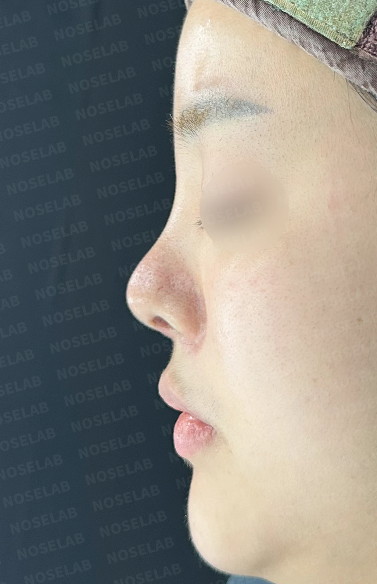 퍼진 콧대와 들린 코끝은 왜 생기나, 늑연골 재건은 어떻게 하나 — 수술 전 / 수술 직후 0일 직후 사진은 부기가 있는 상태로 최종 결과와 다를 수 있습니다.