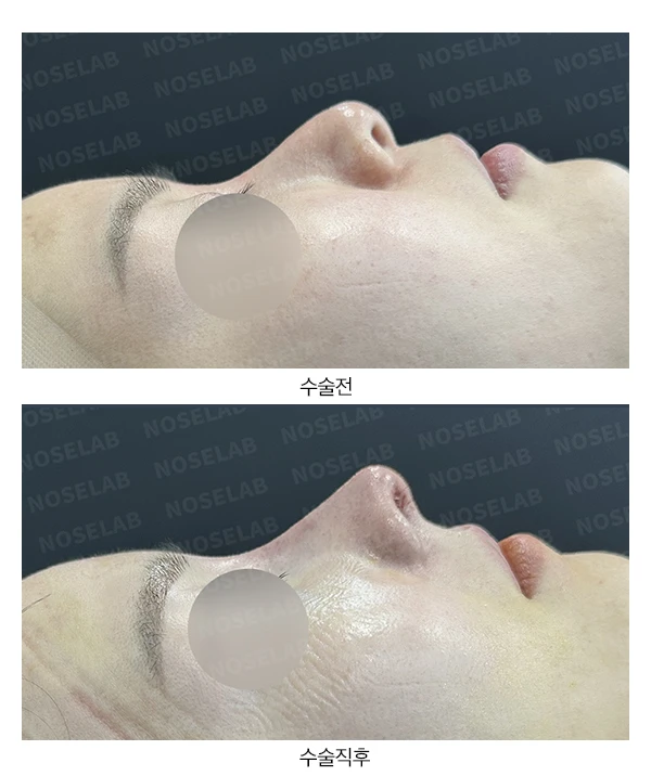 뭉툭하고 처진 코의 구조를 살펴보는 교정 방법 — 전후 비교