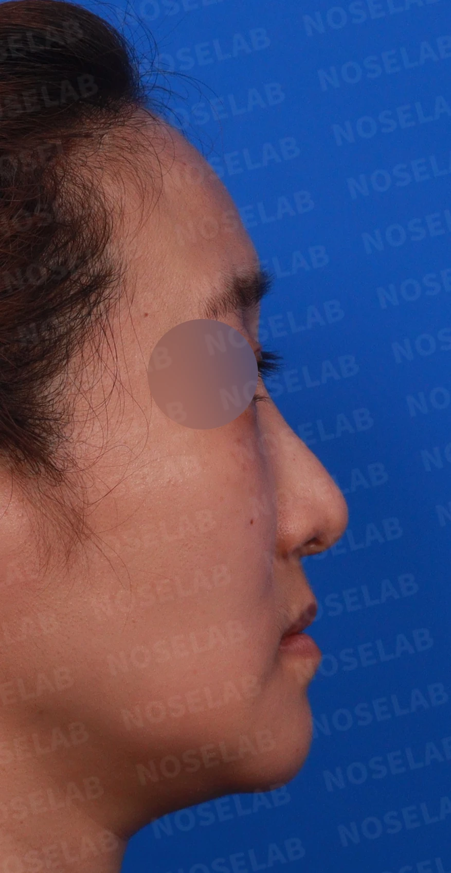 코가 한쪽으로 휘어 보이고 밤에 막히는 이유, 비중격 재건과 코막힘 개선 — 디자인 상담 우측 측면 , 비스듬한 측면 , 비공 사진입니다.