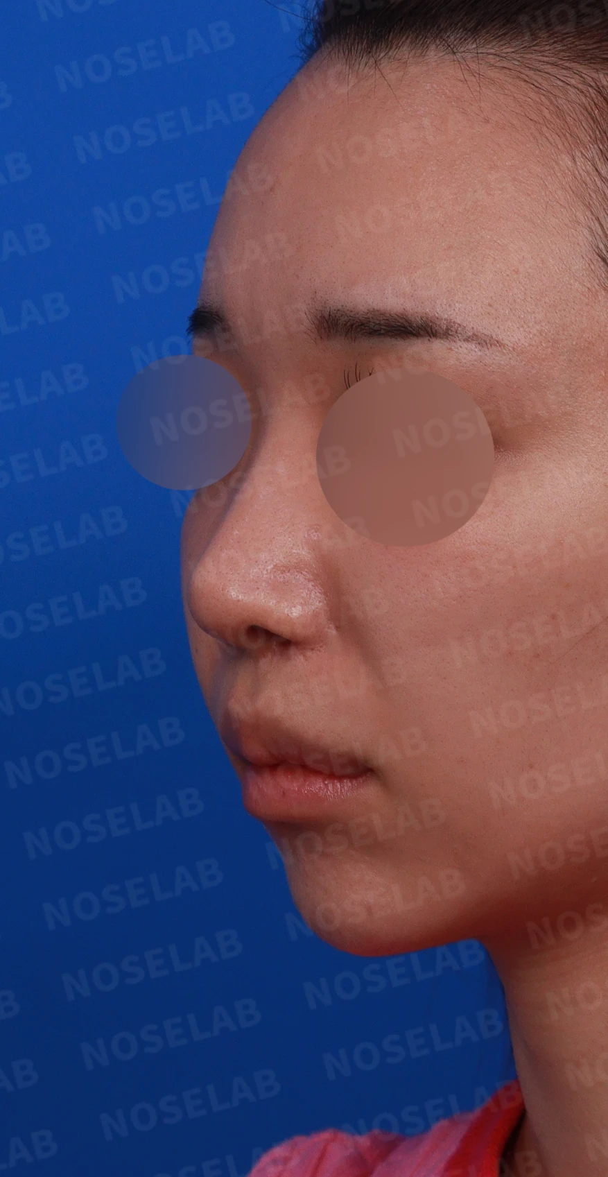 콧구멍 비대칭과 협착이 생기는 이유, 늑연골 재건과 Z성형은 어떻게 하나 — 디자인 상담 정면, 좌측 비스듬한 측면, 측면 사진입니다.