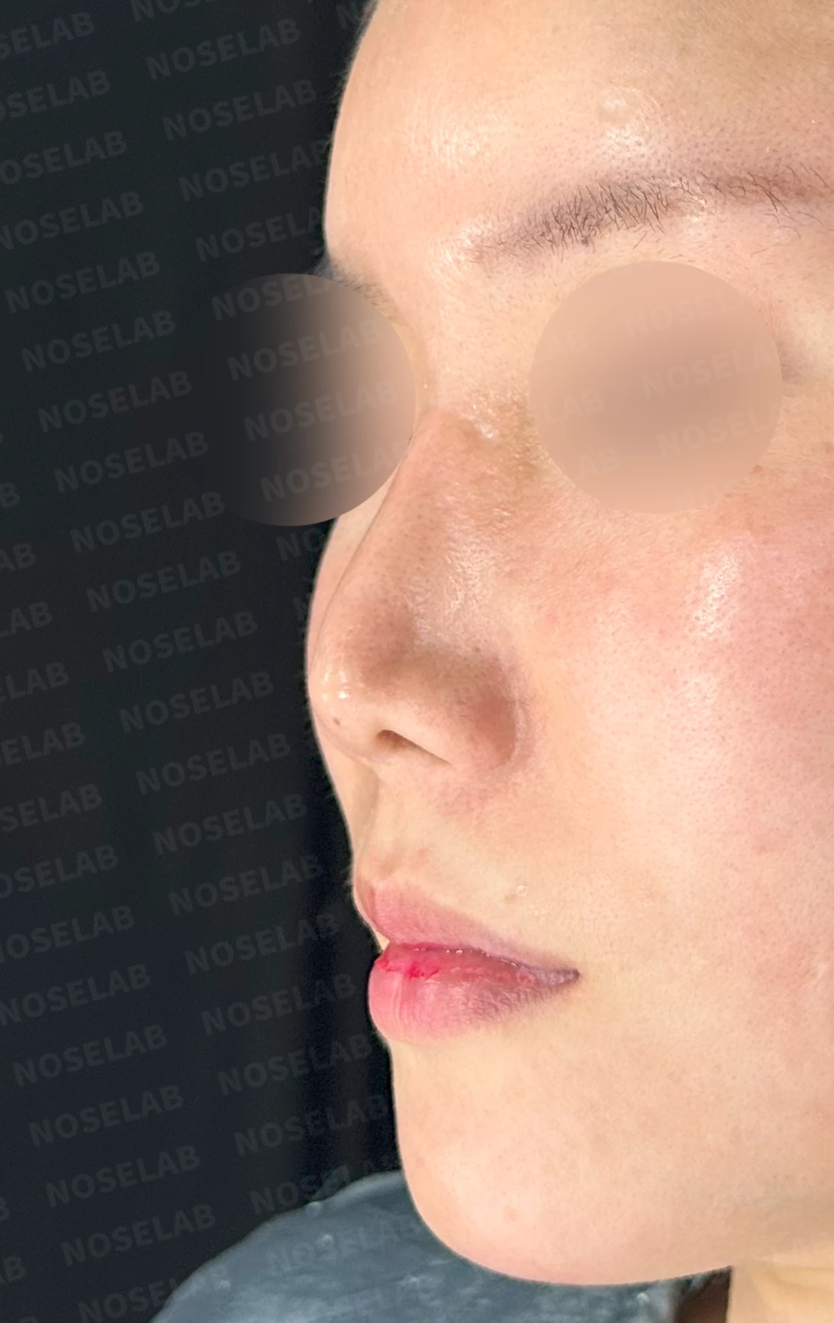 기증 늑연골이 흡수되면 코가 어떻게 변하고, 자가 늑연골 재건은 어떻게 하나 — 수술 전 / 수술 직후 0일 직후 사진은 부기가 있는 상태로 최종 결과와 다를 수 있습니다.