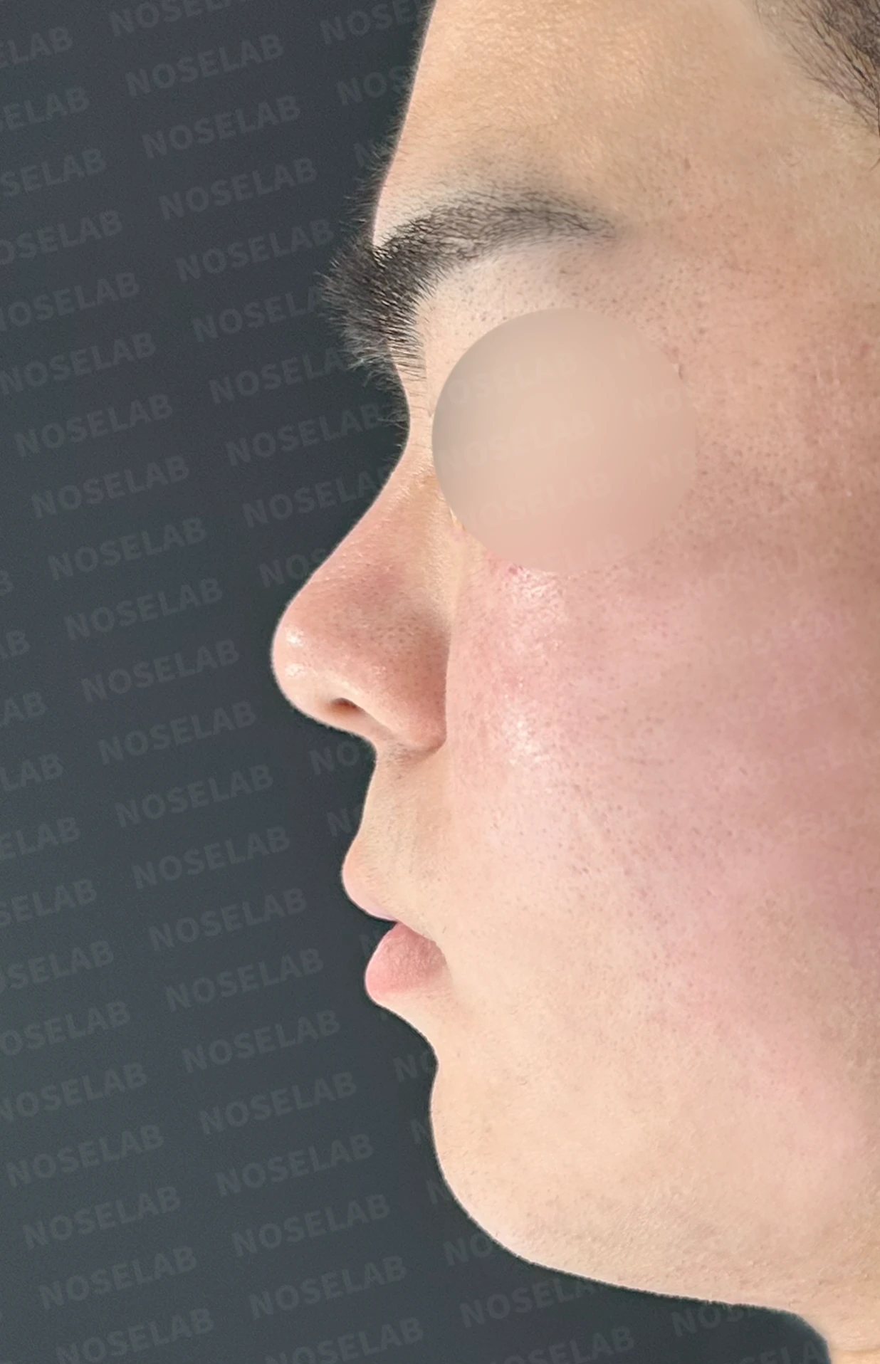짧고 들려 보이는 작은 코, 왜 무리하게 높이지 않는가 — 수술 전 / 수술 직후 0일 직후 사진은 부기가 있는 상태로 최종 결과와 다를 수 있습니다.