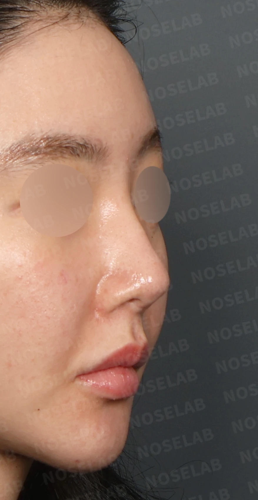 이물질 제거와 자가늑연골 비중격 재건, 들린 코 교정한 코재수술 — 디자인 상담 우측 측면, 비스듬한 측면, 비공 사진입니다.