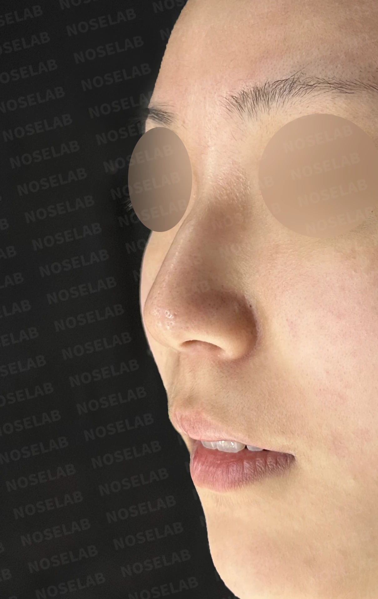 코필러 제거 후 자가늑연골 코성형, 처진 코끝과 메부리코를 자연스럽게 교정 — 전(좌) 직후(후)
