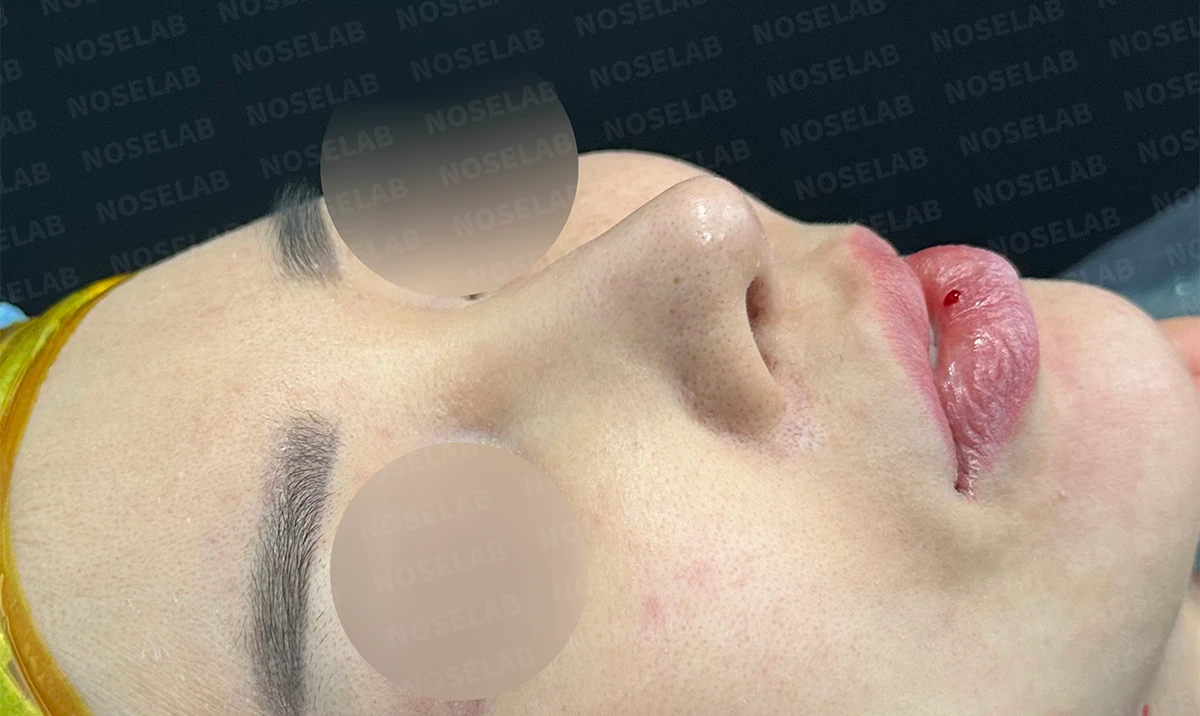 긴코 교정은 어떻게 할까요? — 수술 전 / 수술 직후 0일 직후 사진은 부기가 있는 상태로 최종 결과와 다를 수 있습니다.
