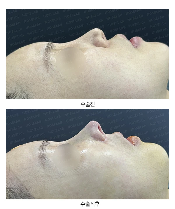높은 콧대 시작점을 낮추는 방법 — 본문 사진 17