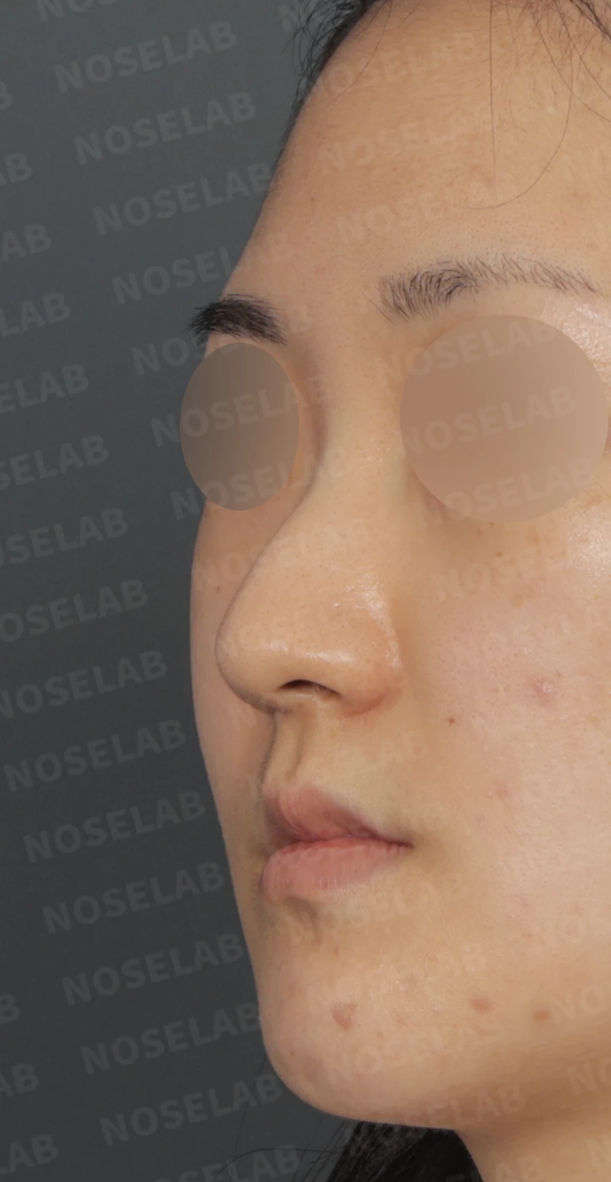 안면 비대칭과 휜코, 자가늑연골 비중격 재건으로 자연스럽게 교정한 코성형 — 디자인 상담 정면, 좌측 측면, 비스듬한 측면 사진입니다.