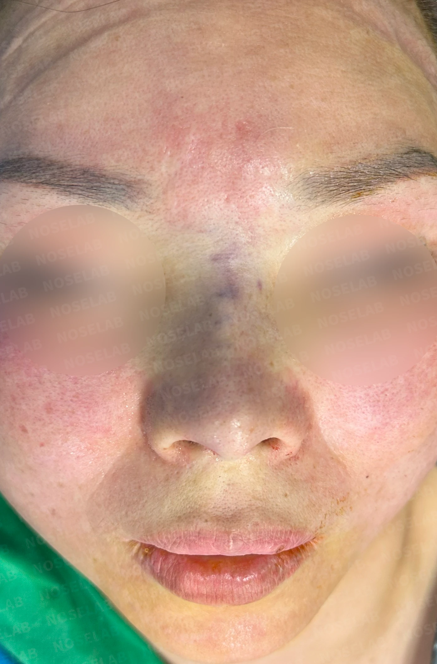 불법 주사 시술 뒤 코가 들리고 짧아지는 이유, 이물질 제거와 재건은 어떻게 하나 — 수술 직후 0일 정면, 측면, 비스듬한 측면 사진 직후 사진은 부기가 있는 상태로 최종 결과와 다를 수 있습니다.