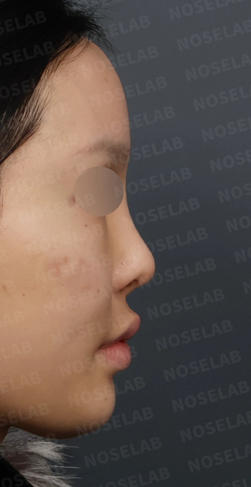 심한 비중격 만곡과 높은 콧대 시작점, 기증늑연골로 정밀 재건 — 디자인 상담 우측 측면, 비스듬한 측면, 비공 사진입니다.
