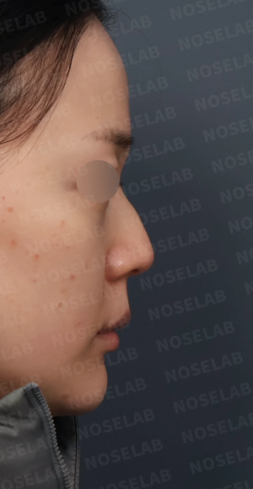 매부리코 교정, 처진 코끝을 오똑하게 바꾸는 비개방 코성형 — 디자인 상담 우측 측면, 비스듬한 측면, 비공 사진입니다.