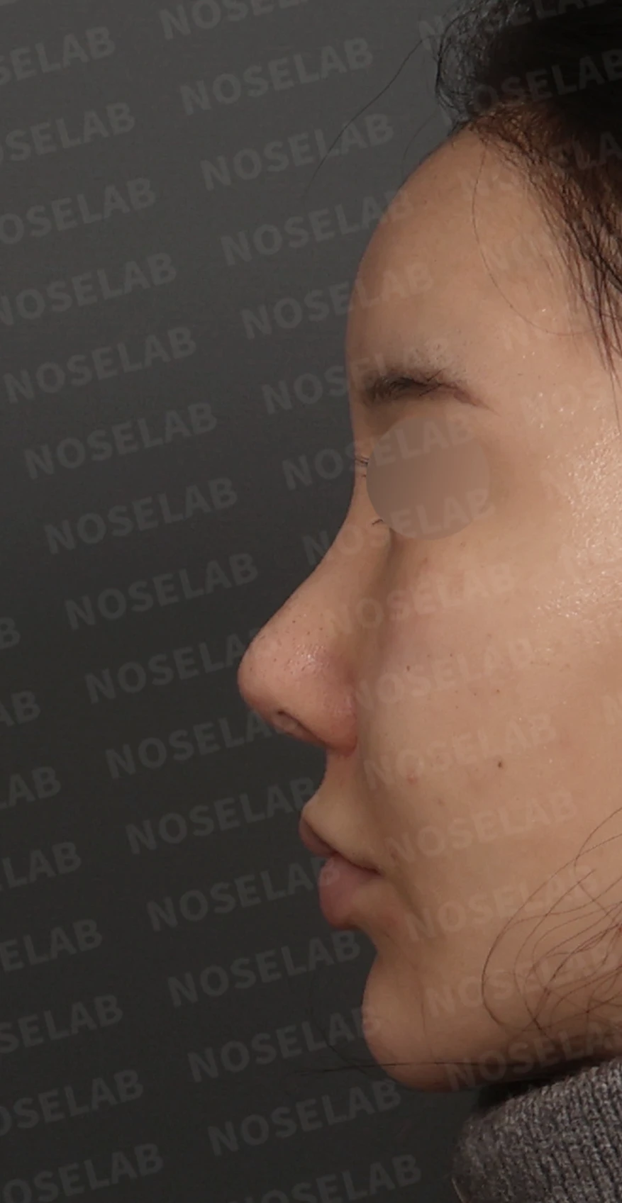 휘어진 코와 비공 비대칭, 자가늑연골 비중격 재건으로 완성한 코재수술 — 디자인 상담 정면, 좌측 측면, 비스듬한 측면 사진