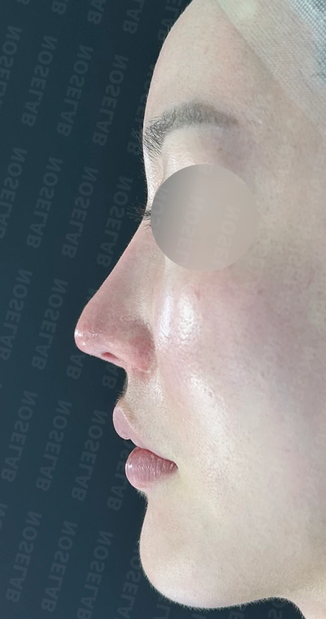 코막힘, 처진코, 비주내리기 코성형 방법 — 본문 사진 2