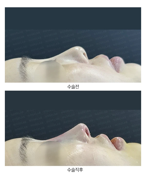 들린코 비공내리기 수술 사례 — 전후 비교