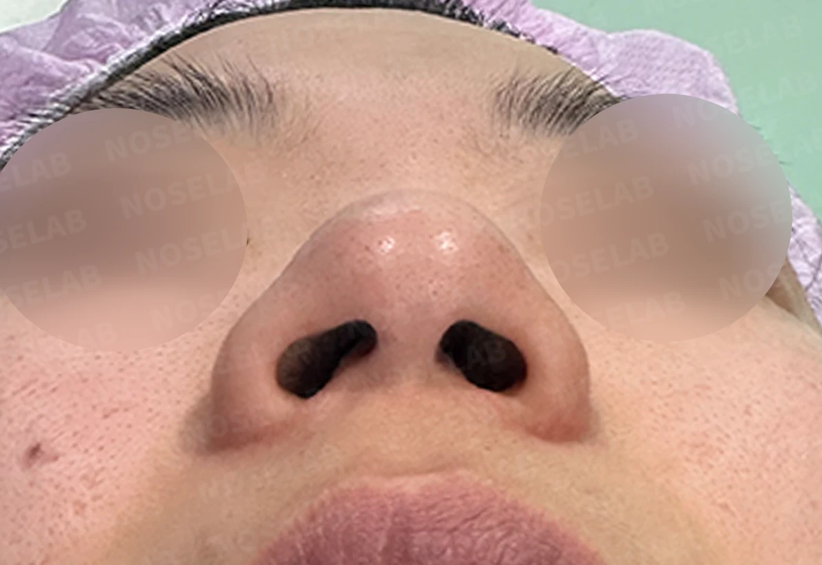복코 수술은 어떻게 하나요? — 수술 전 / 수술 직후 0일 직후 사진은 부기가 있는 상태로 최종 결과와 다를 수 있습니다.