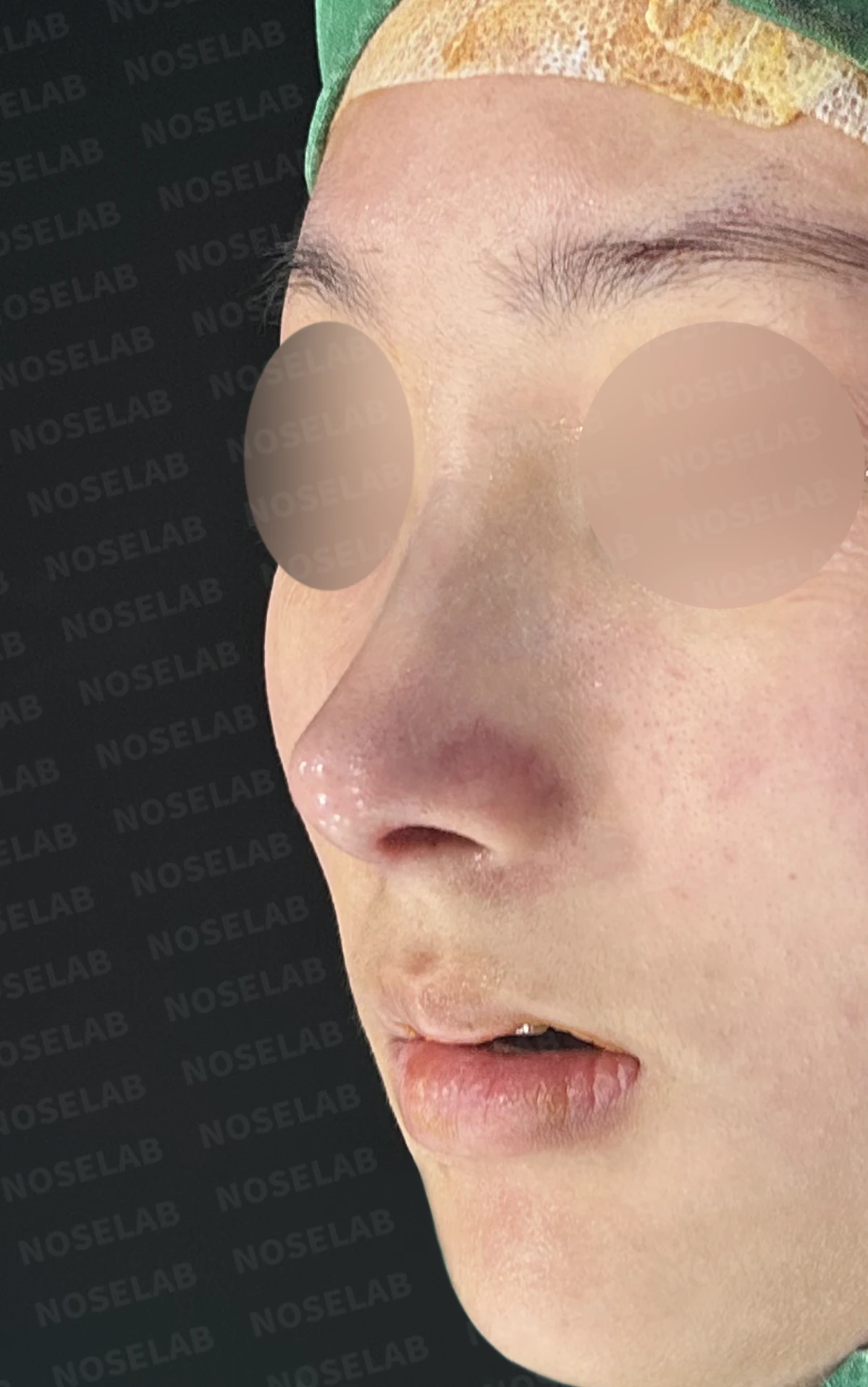 작은 콧날개 연골과 처진 코끝, 자가늑연골과 외측절골술로 자연스럽게 교정 — 수술직후 정면, 비스듬한 측면, 측면 사진입니다.