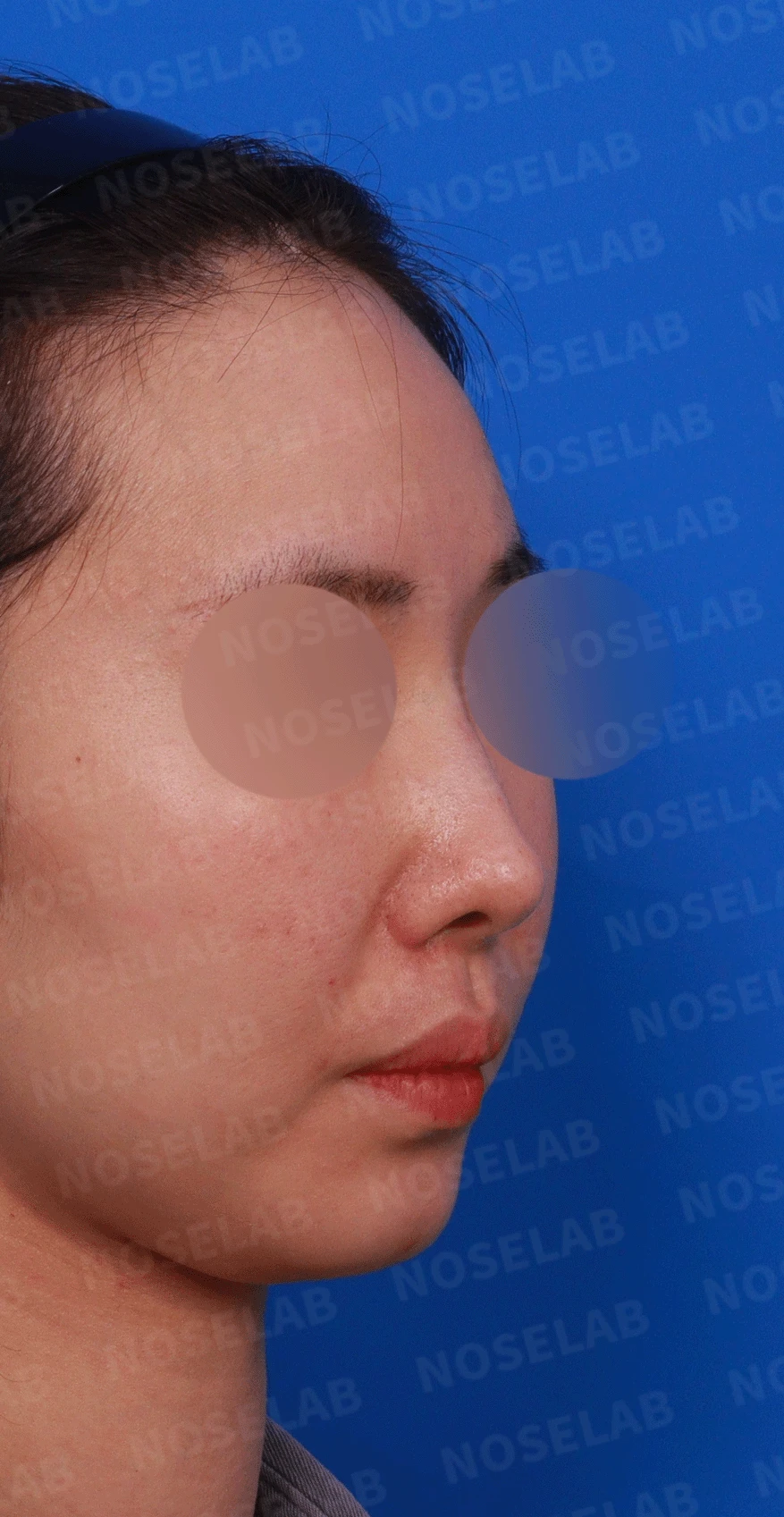 코성형 절골 후 콧등이 꺼지고 한쪽이 막히는 이유, 비밸브 재건과 복원 — 디자인 상담 우측 측면 , 비스듬한 측면 , 비공 사진입니다.