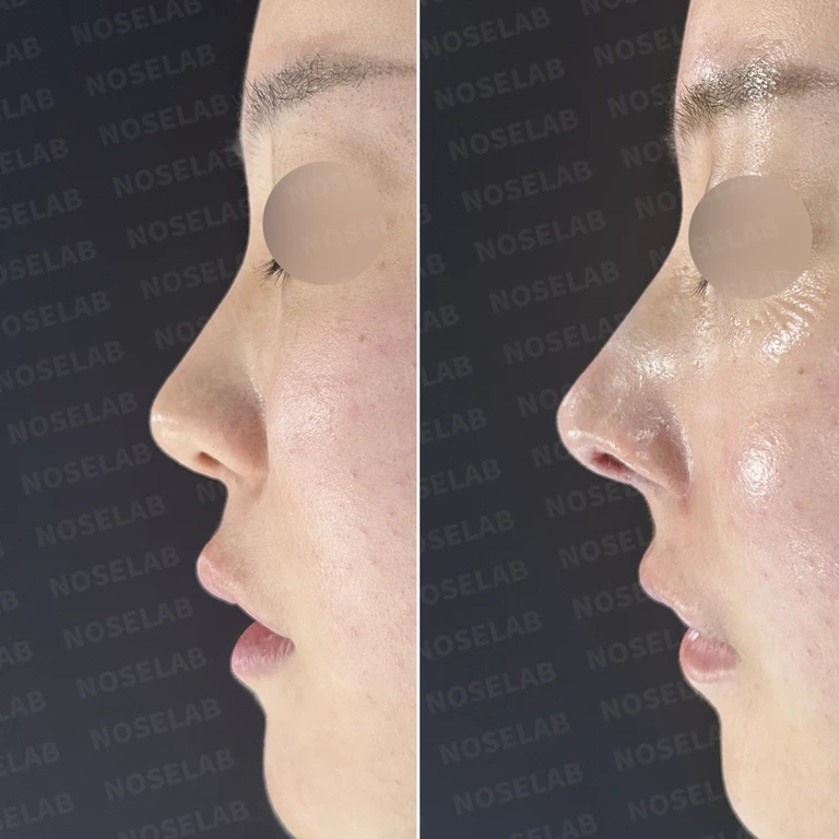 들린코 교정과 코막힘 개선, 자가늑연골로 코재수술 후기 — 전후 비교