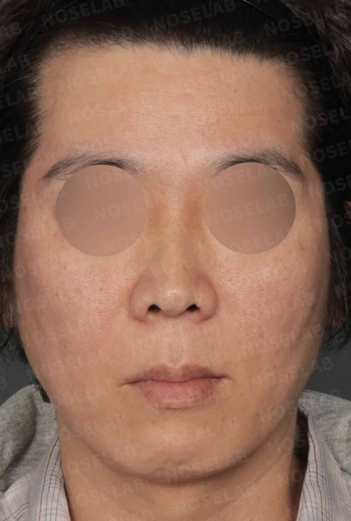 짧고 들린 코와 긴 인중, 자가늑연골로 완성한 남성스러운 직선코 — 디자인 상담 정면, 좌측 측면, 비스듬한 측면