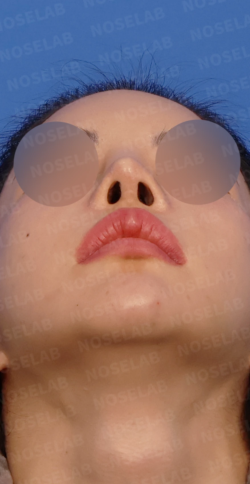 여러 차례 코 수술 뒤 내부 구조가 무너지는 이유와 늑연골 전체 재건 — 디자인 상담 우측 측면, 비스듬한 측면, 비공 사진입니다