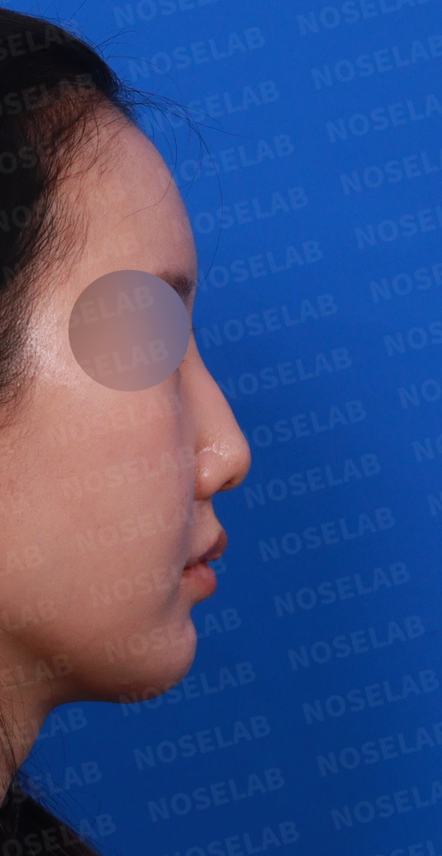 비공 비대칭과 코끝 처짐은 왜 생기나, 연골을 병용한 재건 방법 — 디자인 상담 우측 측면, 비스듬한 측면, 비공 사진