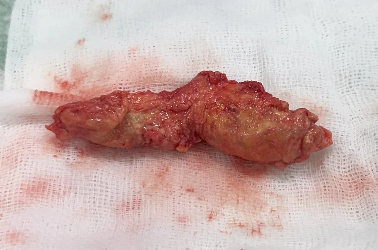 무자격 불법 주사 뒤 콧구멍이 좁아지는 이유와 제거·재건 방법 — 제거된 야매주사 이물질 사진