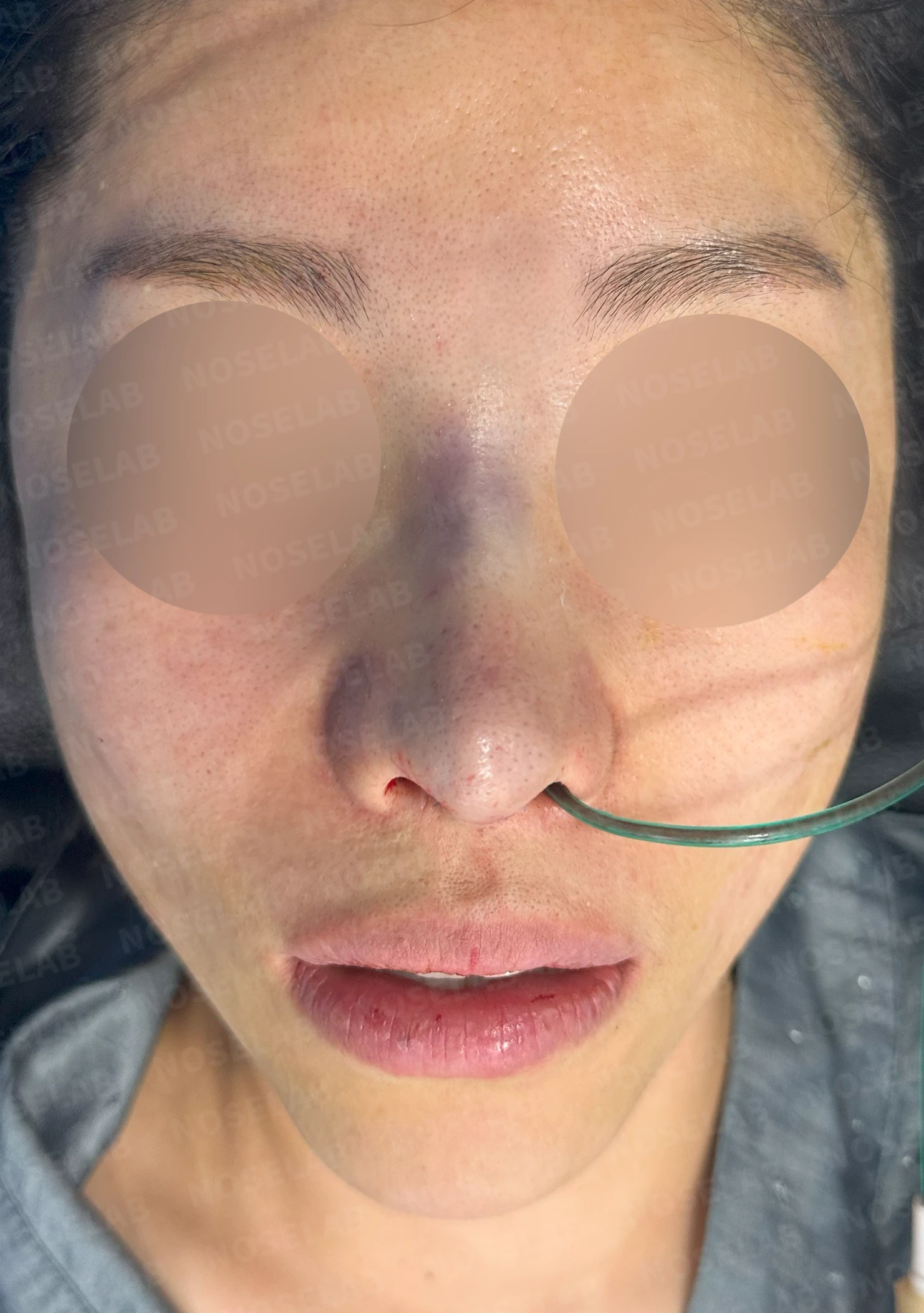 코 수술 뒤 염증이 오래 지속되면 생기는 변화와 재건 방법 — 수술 직후 0일 정면, 비스듬한 측면, 측면 사진 직후 사진은 부기가 있는 상태로 최종 결과와 다를 수 있습니다.