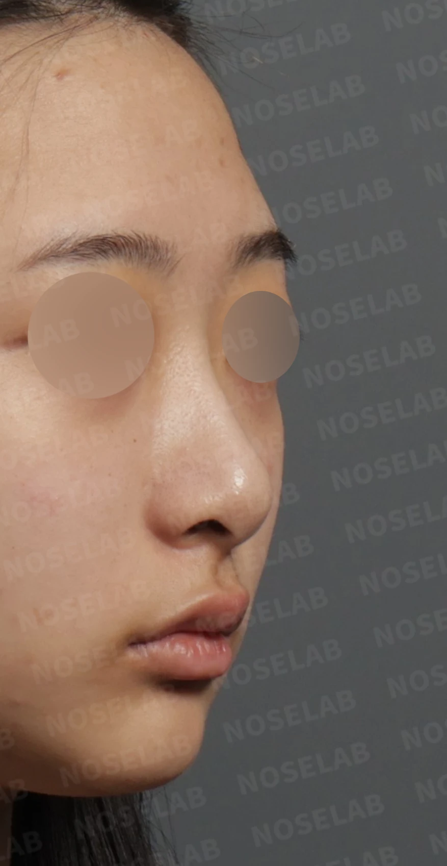 들린 코와 처진 비주, 비중격연장술로 자연스러운 직반라인 완성한 코성형 — 디자인 상담 우측 측면, 비스듬한 측면, 비공 사진입니다.