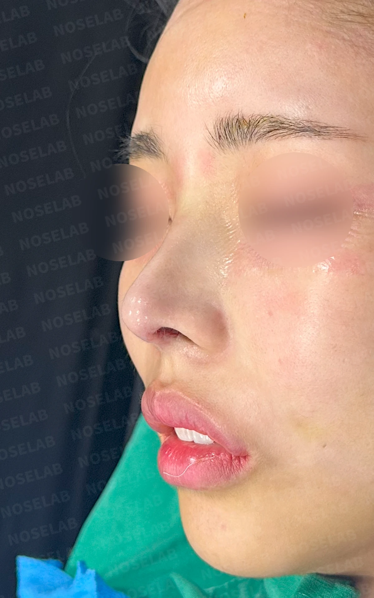 적절하지 않은 L자 실리콘 개선 - 안전한 구조로 재건 후기 — 전(좌) 직후(우)