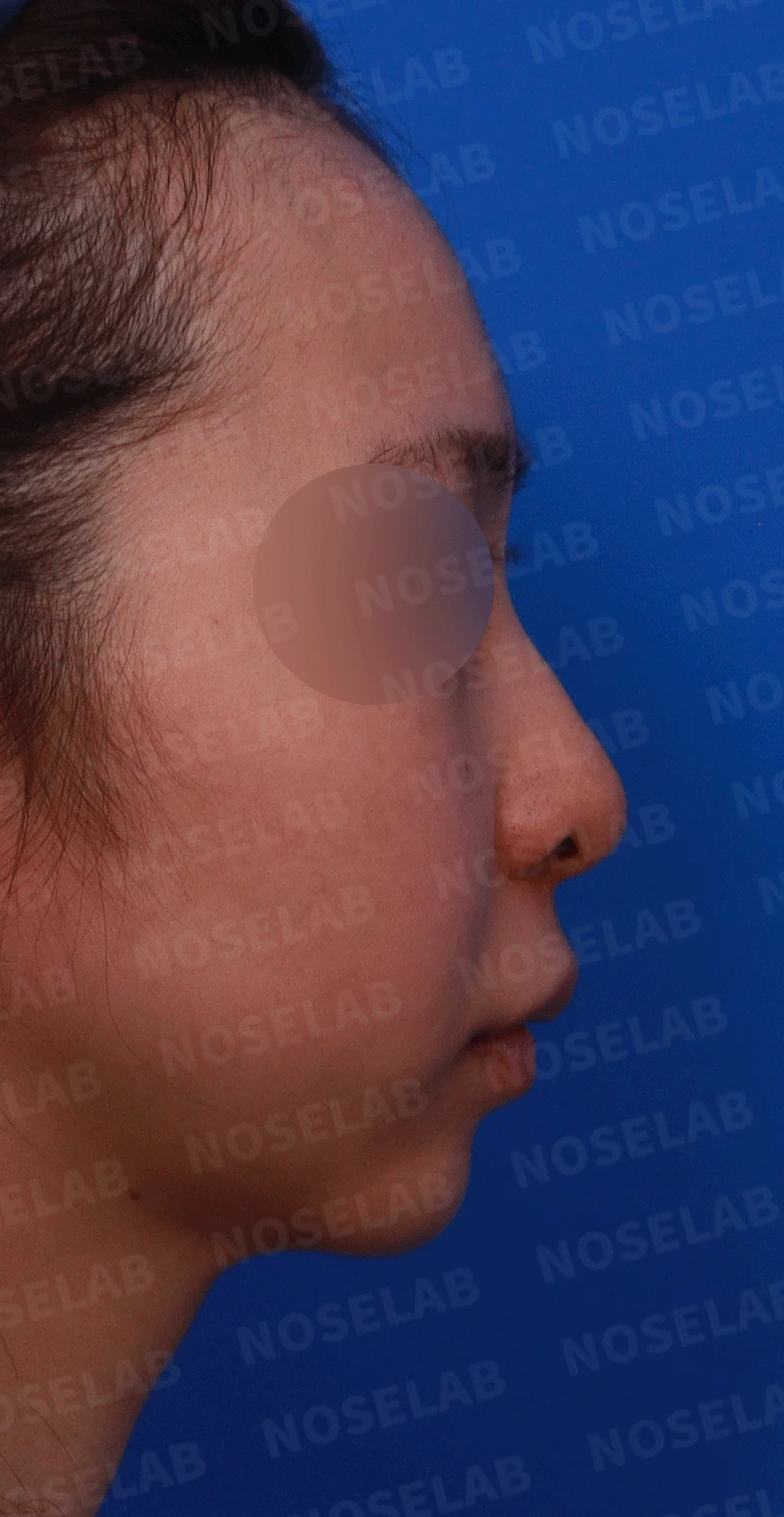 여러 번 수술해도 콧대가 낮고 복코가 남는 이유, 늑연골 재건과 얼굴 균형 — 디자인 상담 우측 비스듬한 측면 , 측면 , 비공 사진입니다.