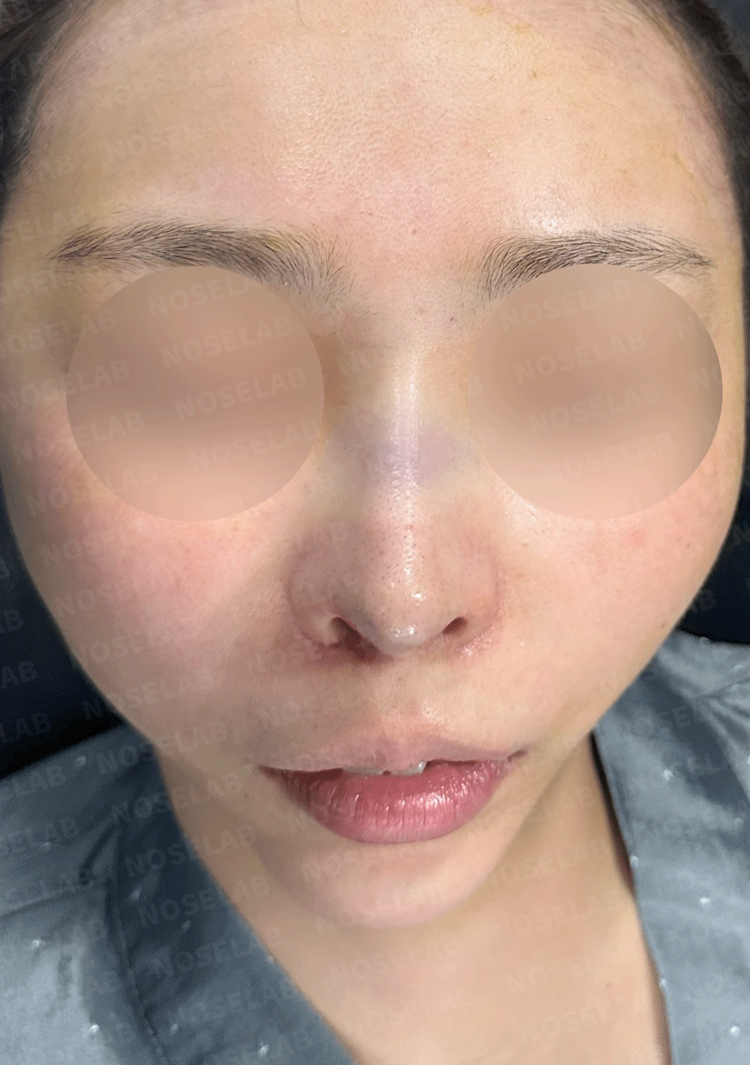 여러 번 수술해도 콧대가 낮고 복코가 남는 이유, 늑연골 재건과 얼굴 균형 — 본문 사진 8