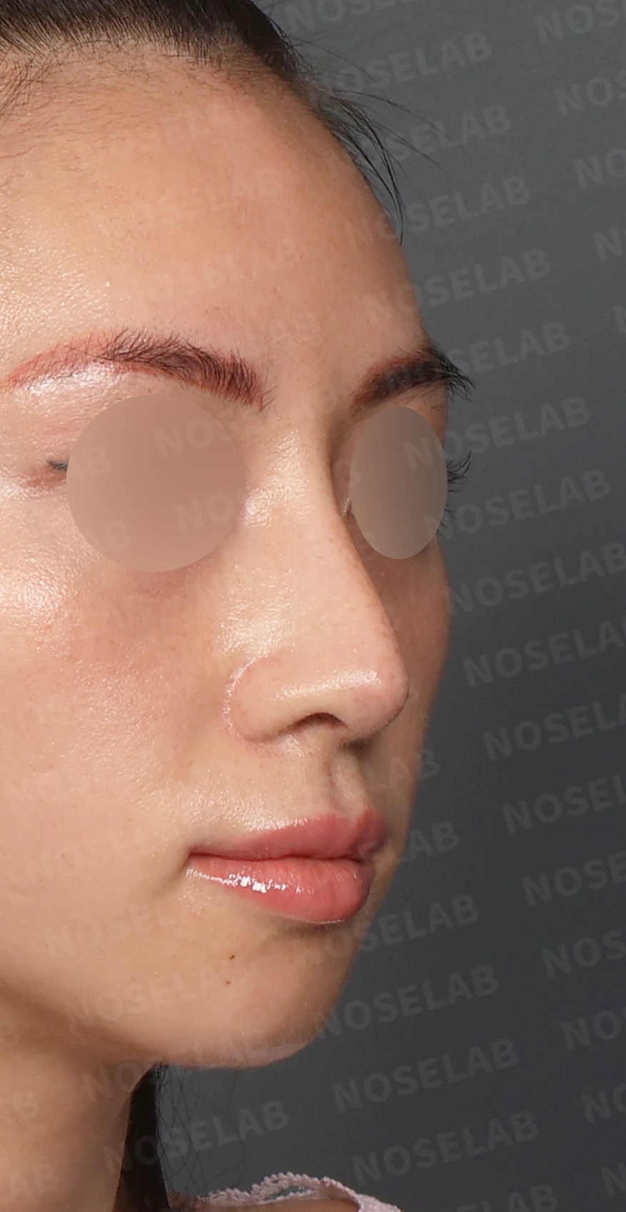 자가 늑연골 코재수술, 콧대부터 코끝까지 슬림하고 여성스럽게 — 디자인 상담 우측 측면, 비스듬한 측면, 비공 사진 입니다.