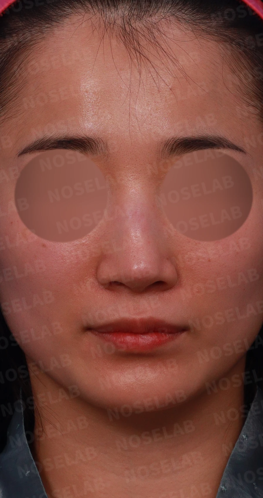 메드포어 점막 돌출로 인한 염증 코 - 자가늑연골 재건 수술 후기 — 디자인 상담 정면, 좌측 측면, 비스듬한 측면 사진