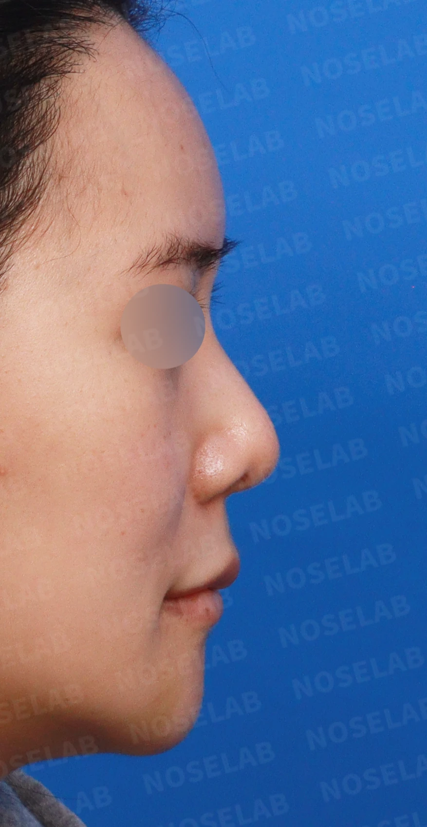 들린 코와 한쪽만 찝힌 콧구멍이 생기는 이유, 무보형물 재건은 어떻게 하나 — 디자인 상담 우측 측면, 비스듬한 측면, 비공 사진입니다.