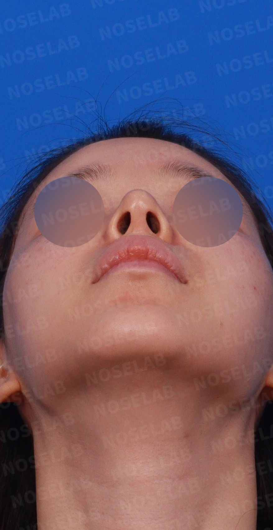 귀연골만으로 코끝을 받쳤을 때 생기는 변화와 늑연골 재건 방법 — 디자인 상담 우측 측면, 비스듬한 측면, 비공 사진입니다.