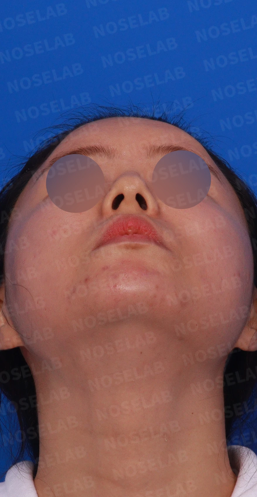 녹지 않고 남은 코 필러와 넓은 콧날개, 원인과 제거·교정 방법 — 디자인 상담 우측 측면 , 비스듬한 측면 , 비공 사진입니다.