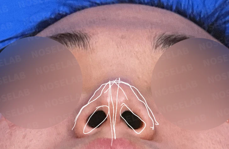 휜코 교정하면 안면 비대칭이 좋아질까요? — 수술전 콧구멍 사진