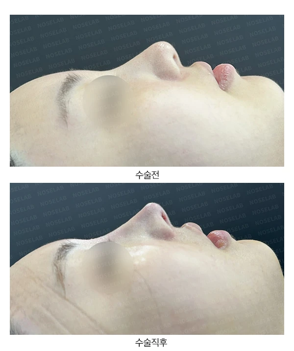 퍼진 코 개선과 콧구멍 비대칭 교정수술 사례 — 전후 비교