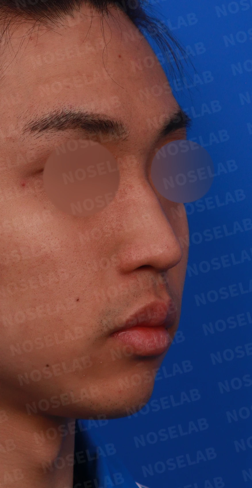 비염 수술 뒤에도 증상이 재발하는 이유, 휜 코를 함께 교정하는 방법 — 디자인 상담 우측 비스듬한 측면, 측면, 비공 사진
