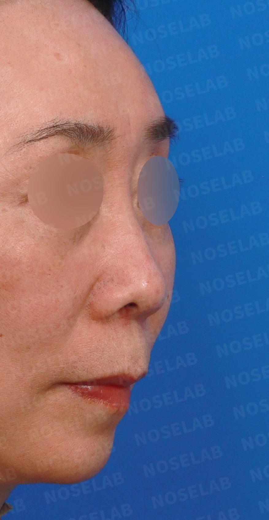 정면에서 콧구멍이 한쪽만 더 보이는 이유와 코끝 재건 방법 — 디자인 상담 우측 측면, 비스듬한 측면, 비공 사진입니다.