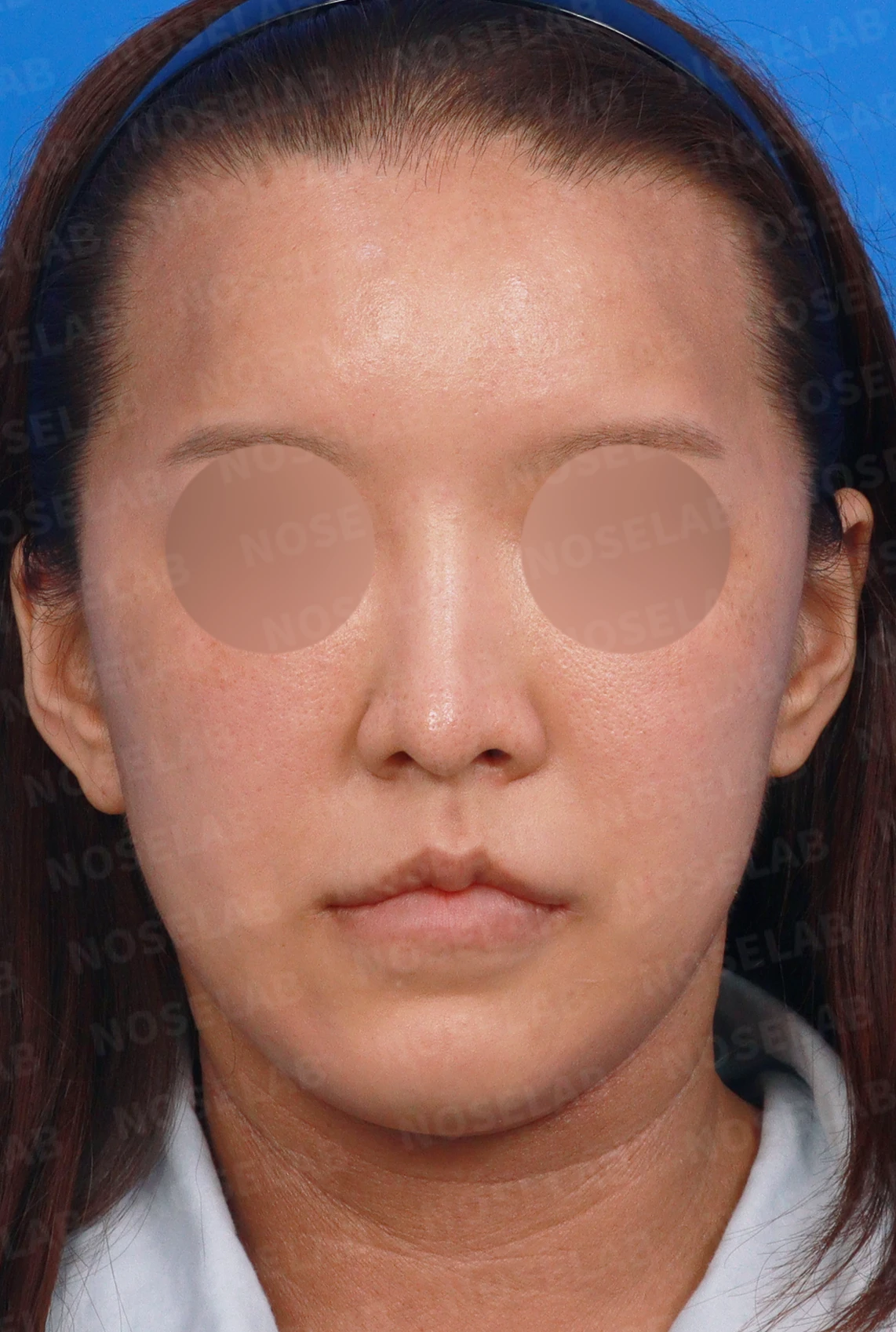 휜 코 교정과 코막힘 개선, 두 마리 토끼를 잡은 성공 사례 — 디자인 상담 정면, 좌측 측면, 비스듬한 측면 사진입니다.