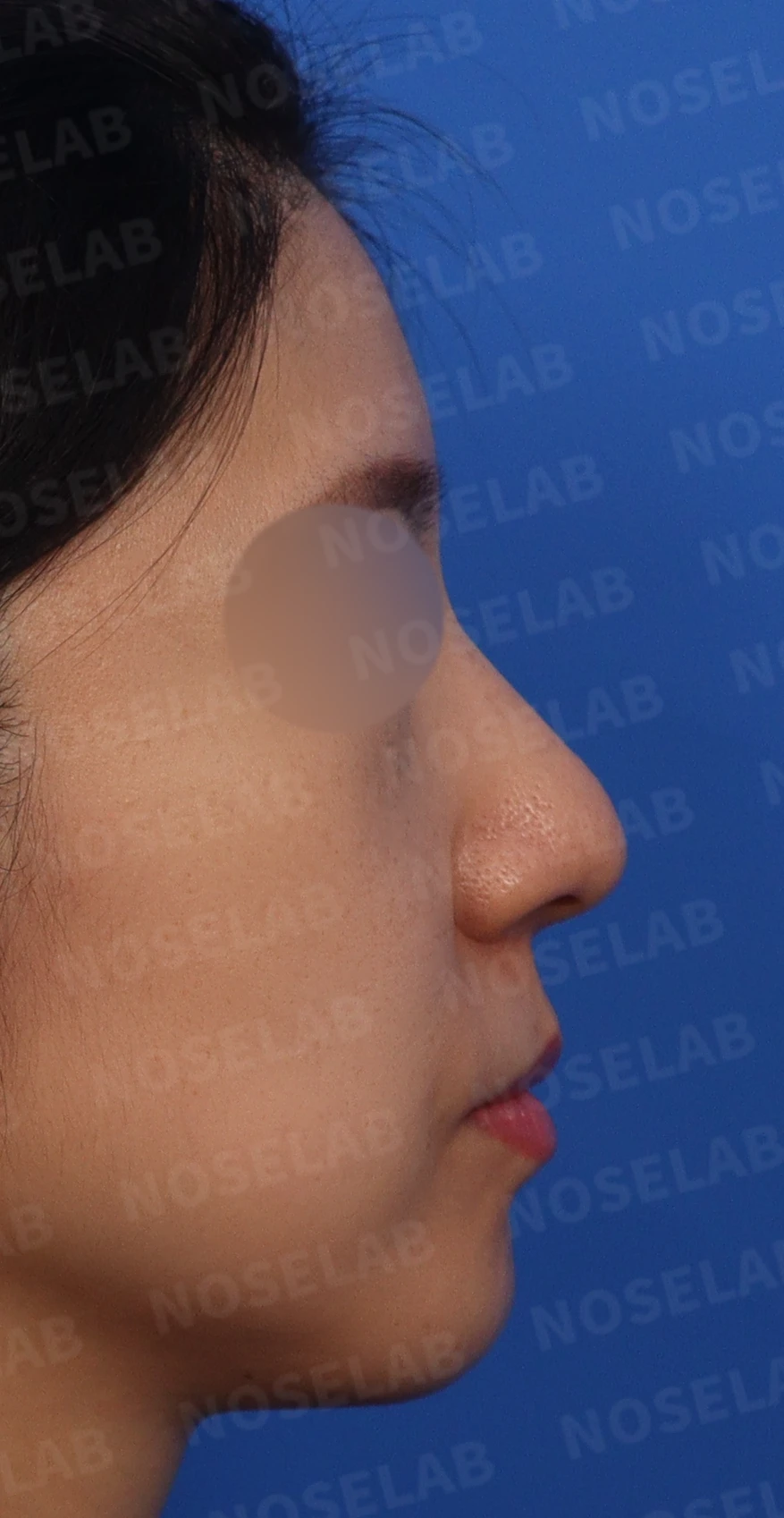 복코, 퍼진코 교정 방법 — 본문 사진 2