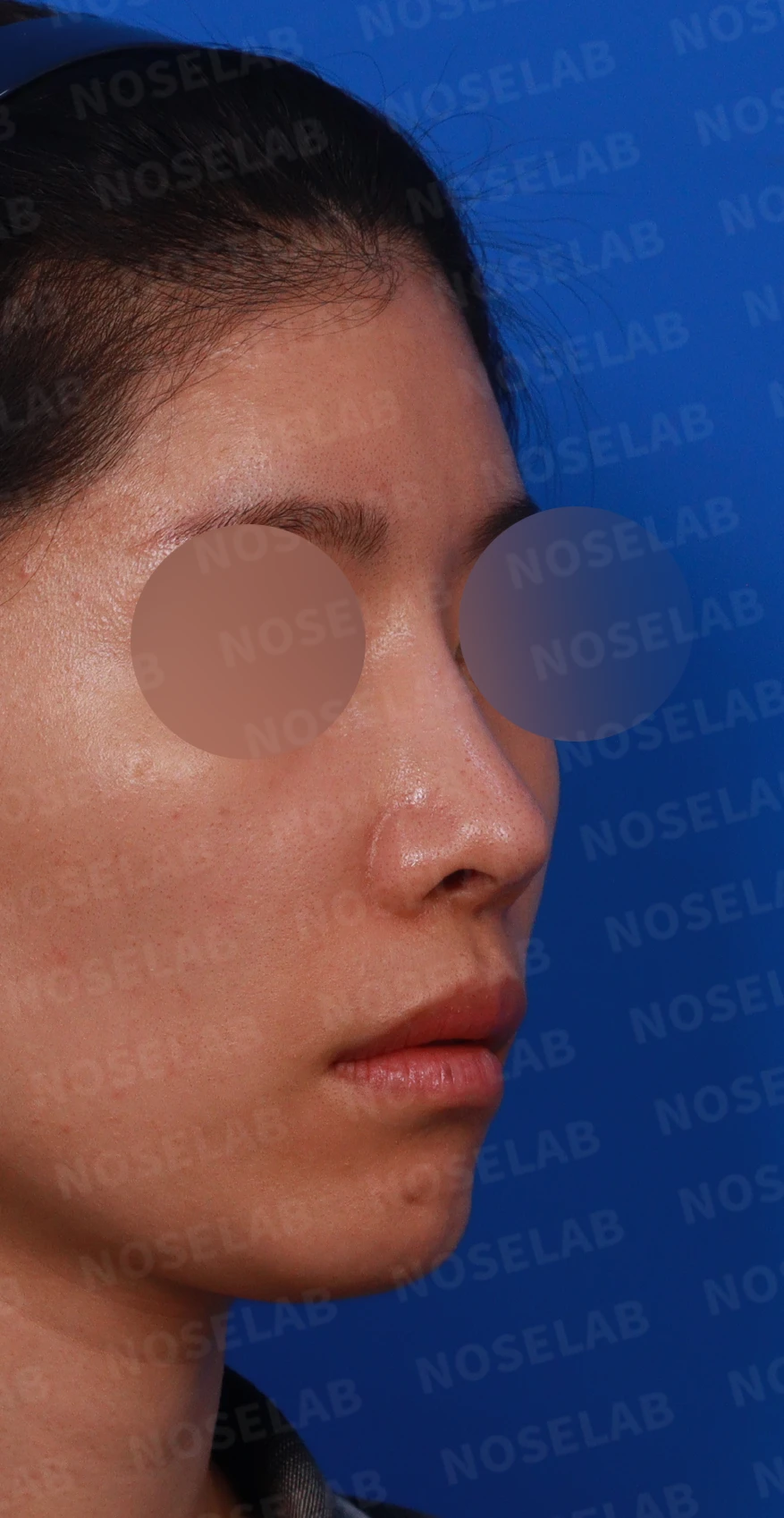 코 수술 뒤 염증이 오래 지속되면 생기는 변화와 재건 방법 — 디자인 상담 우측 측면, 비스듬한 측면, 비공 사진입니다.