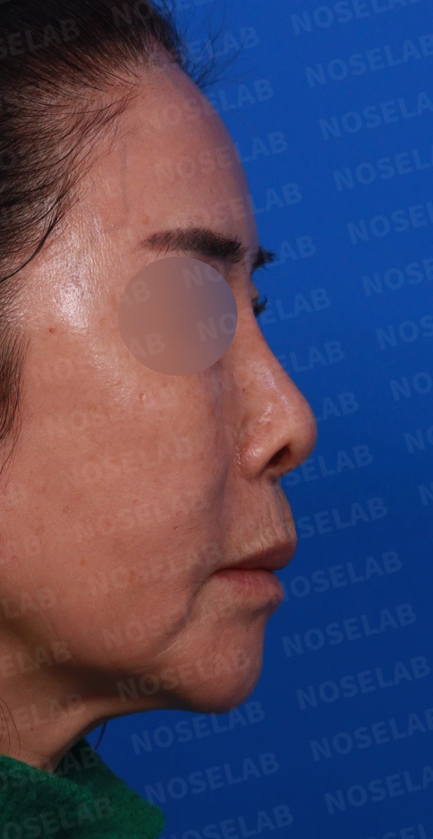 오래된 실리콘 보형물이 변형과 통증을 일으키는 이유, 늑연골 재건은 어떻게 하나 — 디자인 상담 우측 비스듬한 측면, 측면, 비공 사진